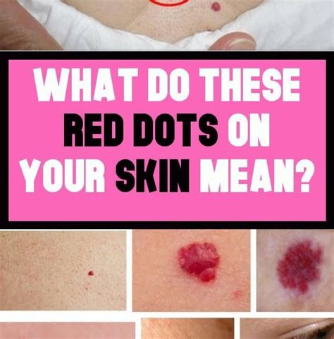 Why Do I Have Random Red Dots On My Face - Printable Templates Protal