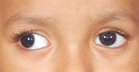 PHFI CEHJ » Common eye diseases in school going children