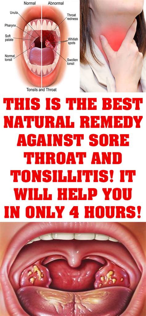 THIS IS THE BEST NATURAL REMEDY AGAINST SORE THROAT AND TONSILLITIS! IT WILL HELP YOU IN ONLY 4 ...