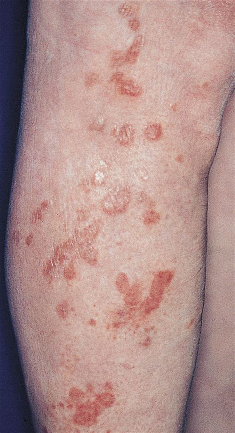 Successful Treatment of Cutaneous Sarcoidosis Using Topical Photodynamic Therapy | Dermatology ...