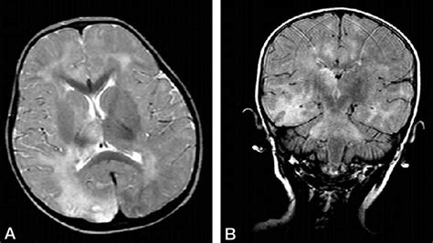 Subacute sclerosing panencephalitis causes, symptoms, diagnosis ...