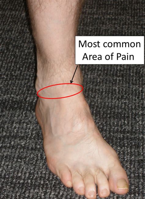 Anterior Ankle Impingement - FootEducation