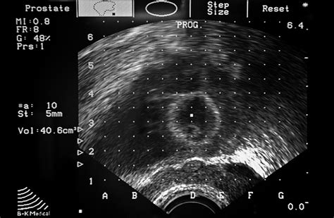 Transrectal Ultrasound Prostate Biopsy