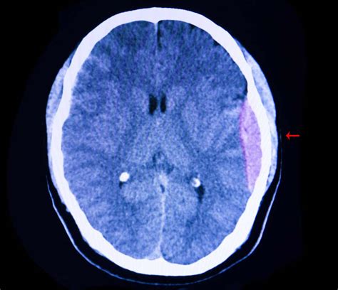 Subdural Vs Epidural Hematoma - BheinnFarhana