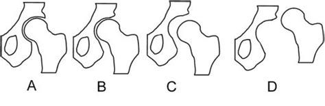 Barlow and Ortolani Tests - Physiopedia