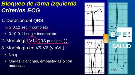 Bradicardia: Bloqueos de rama izquierda y derecha - YouTube