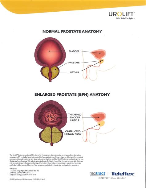 Understanding Enlarged Prostate's Impact | Mason City Clinic