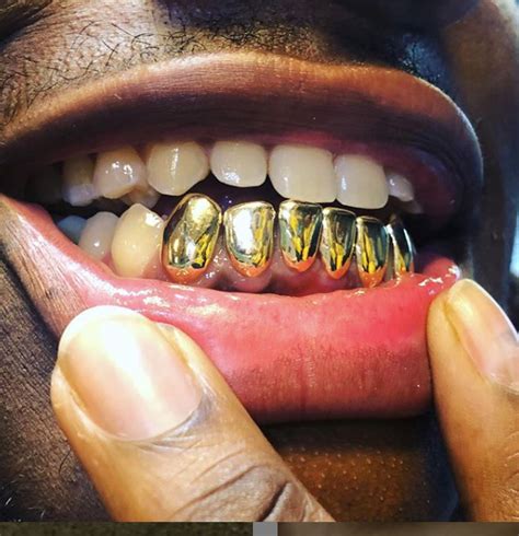 How Much Does Permanent Gold Teeth Cost? - A Best Fashion