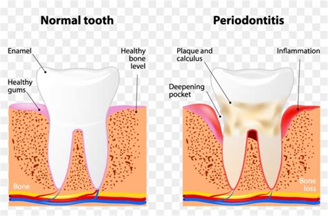 Dental Deep Cleaning - Scaling And Root Planing, HD Png Download - 934x574(#5145195) - PngFind