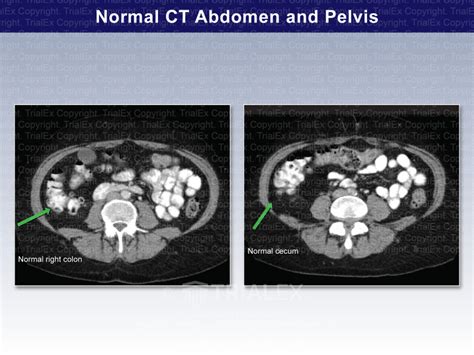 Normal CT of Abdomen and Pelvis - TrialQuest Inc.