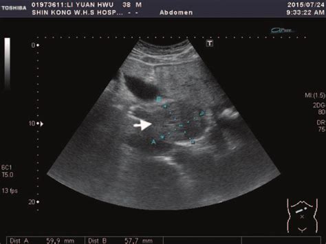 Liver Cancer Ultrasound