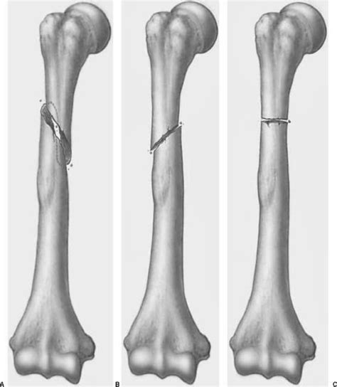 Humeral Shaft Fractures | Radiology Key