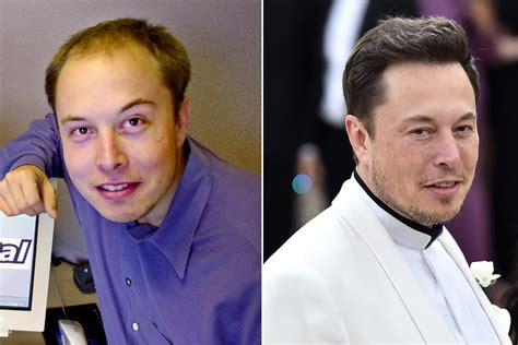 It's 'highly likely' Elon Musk spent over $20K on hair transplant surgery, doctor says