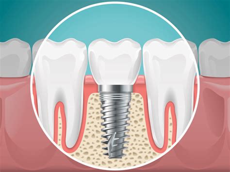 » Dental Implant Failure Rates: Are They Worth the Risk?