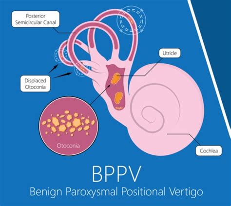 Benign Paroxysmal Positional Vertigo