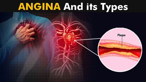 What is Angina And How it Works? | Types, Causes, Symptoms and treatment (3D Animation) - YouTube