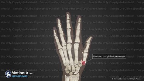 Closed Reduction & Percutaneous Pinning of Thumb - MotionLit