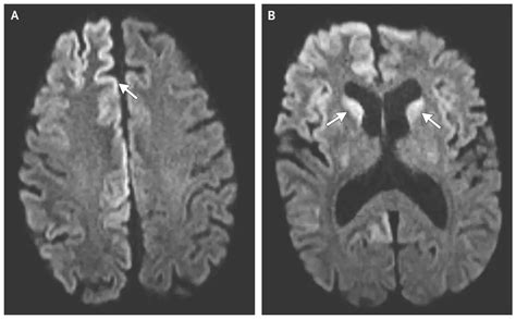 Creutzfeldt-jakob Disease: Causes and Symptoms | Healthtian