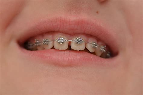 Kids are doing DIY braces on YouTube and the results are scary