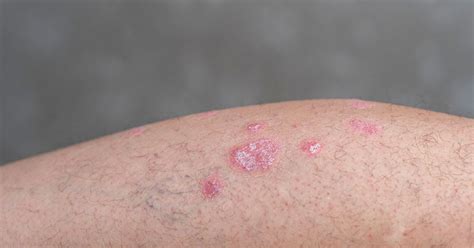 Psoriasis Vulgaris: Overview and Treatment Options