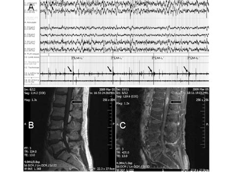 Polysomnogram and lumbosacral spine MRI. A: Overnight polysomnography... | Download Scientific ...