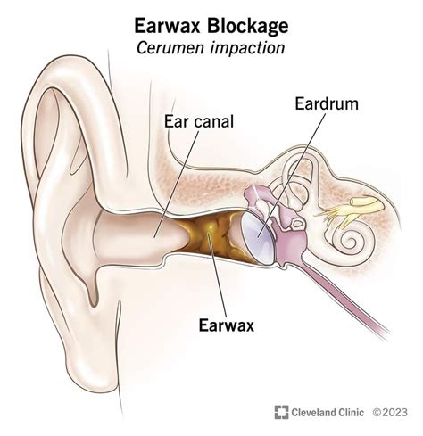 Common Causes of Earwax Build-up - Ask The Nurse Expert