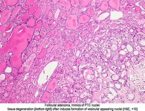 Pathology Outlines - Papillary thyroid carcinoma