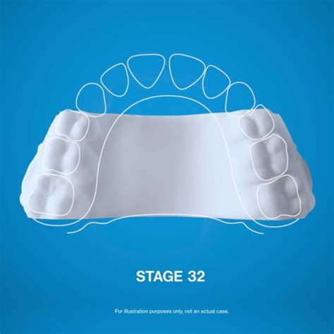 Invisalign® Palatal Expander | Invisalign.com