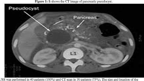 Figure 1 from A clinical study of Pancreatic pseudocyst and its management: An institutional ...