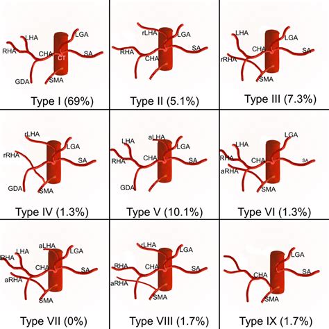 Schematic representation of hepatic artery variants in our study... | Download Scientific Diagram