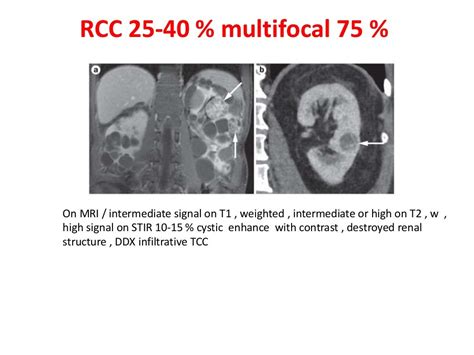 Von hippel –lindau disease