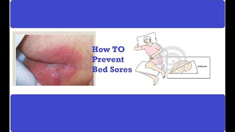 Prevent Bed Sores