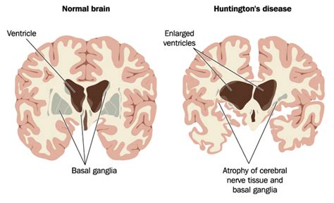 View 23: Huntington's Disease Brain Atrophy | PENULIS | PENULIS ARTIKEL ...