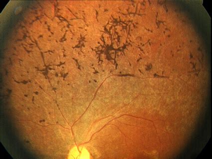 Retinitis pigmentosa - Causes, Symptoms, Diagnosis, Treatment and Pictures