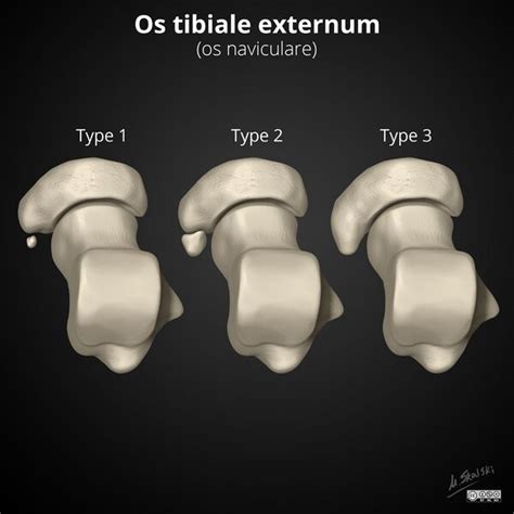 Accessory Navicular Bone - Physiopedia