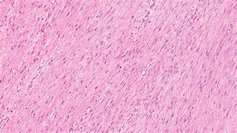 Fibromatosis | MyPathologyReport.ca