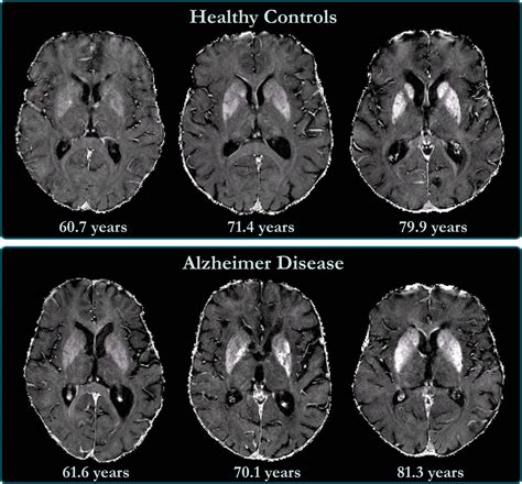 Brain iron accumulation linked to cognitive d | EurekAlert!