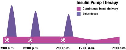 Insulin Pump - Insulin Pump