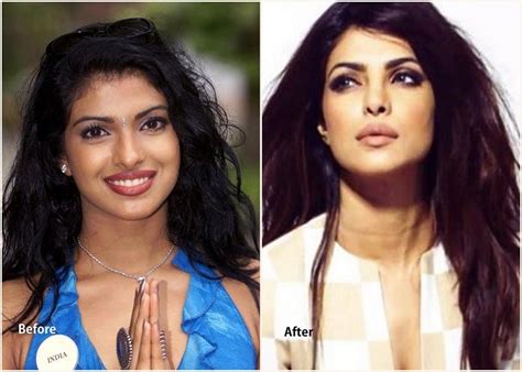 7 Bollywood Plastic Surgeries That are Successful