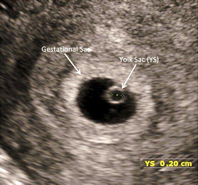 Introduction to First-Trimester Point-of-Care Ultrasound - Point-of ...