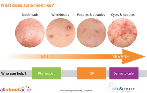 What Type of Acne Do You Have? Types of Acne Explained - Skinive: Skin Health AI-Tracking apps