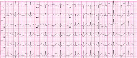 Initial ECG of the patient showing sinus tachycardia | Download Scientific Diagram