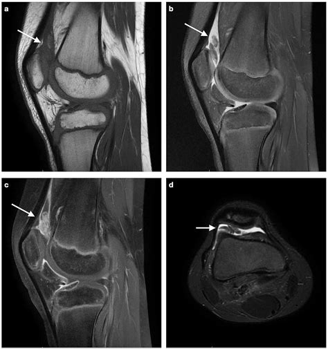 Cureus | Pigmented Villonodular Synovitis of the Knee Joint in a 10 ...