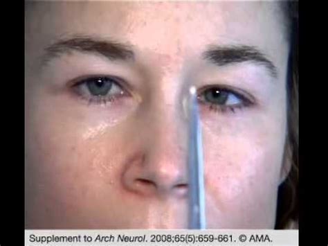 Syndrome of Ocular Flutter, Myoclonus, and Ataxia of the Trunk - YouTube