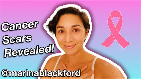 Breast Cancer Surgery Scars; port, lumpectomy & mastectomy scars healed - YouTube