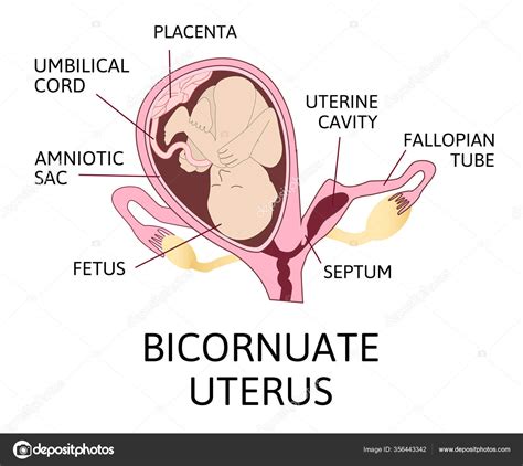 Bicornuate Uterus Pregnancy One Uterine Fetus Child Second Uterine ...