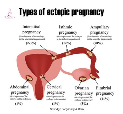 Top 95+ Pictures The Feathery Ends Of The Fallopian Tubes Are The ...