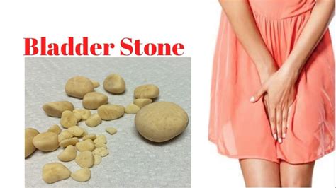 Bladder Stones - Causes, Diagnosis, Symptoms, Removal & Treatment