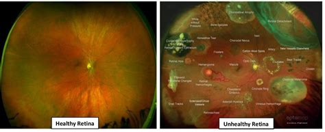 Optomap Form | Image Eyecare Optometry