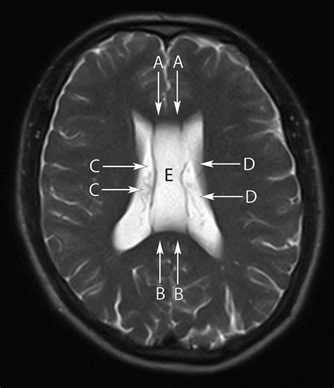 Septum Pellucidum And Lateral Ventricle